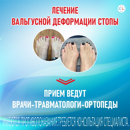 Вальгусная деформация стопы