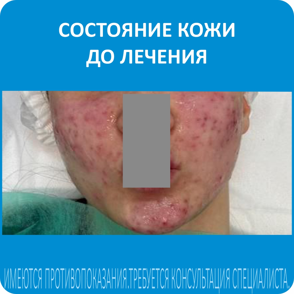 Состояние кожи До лечения