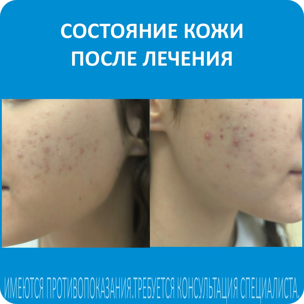 Состояние кожи После лечения